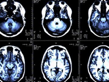 MR-scanning af hjerne/hoved