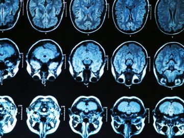 Scanningsbillede af hjerne